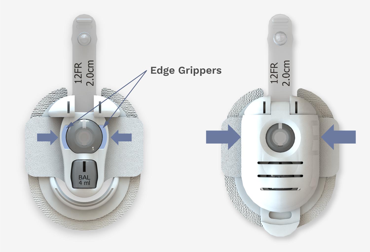 Button Huggie edge grippers pinch to stabilize g-tube