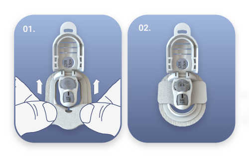 hands sliding custom gauze pad into button huggie gtube securement device