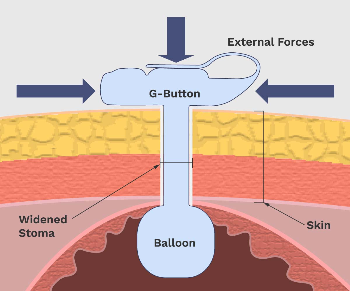 external forces widening stoma of gastrostomy button