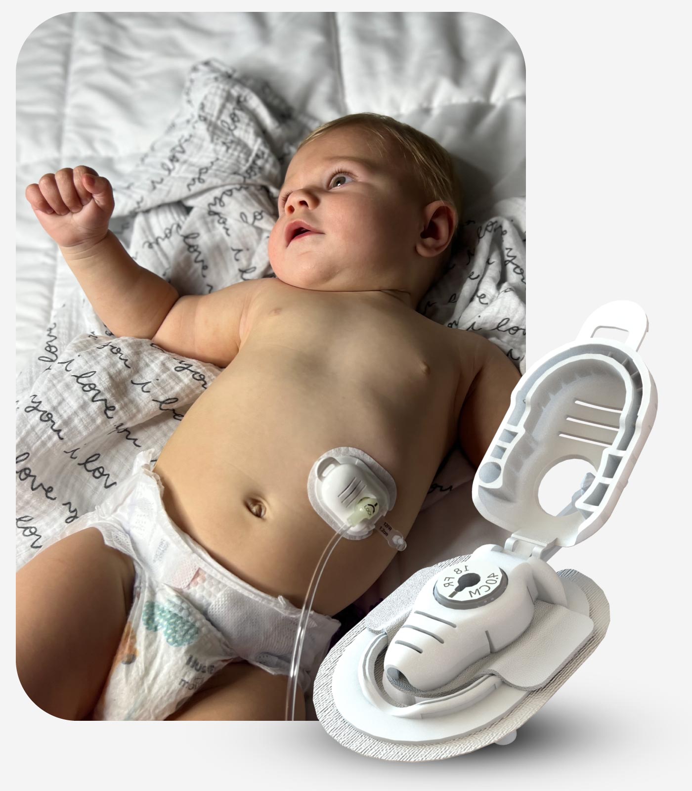 Button Huggie G-button Securement device on a pediatric patient with feeding tube attached